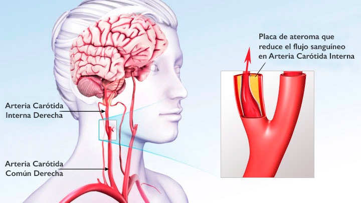 Enfermedad Cerebrovascular Dr Lucien Chassin Trubert 6156